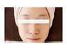 【ワンランク上】しみ・しわ・たるみに◎エクソソーム導入￥18500⇒￥13500