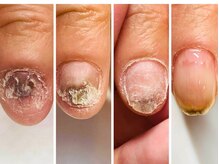 クウ(KUU)/深刻な深爪にも対応