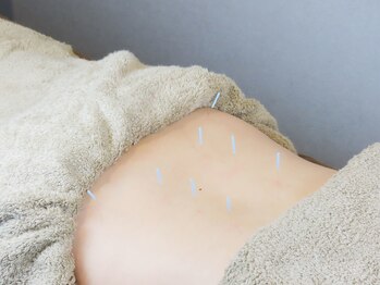 ジェネラス 鍼灸院 整骨院(GENEROUS)/腰へ鍼