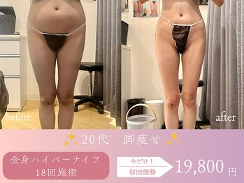 スリムプロ 天王寺店(Slimpro)/下半身引き締め