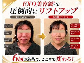 ビーネ トウキョウ 渋谷(Beene TOKYO)の写真/芸能人御用達”結果重視”美容鍼×痩身鍼灸”丁寧なカウンセリングと施術が好評◎初回限定￥1980～