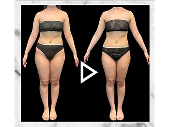 エステティック エイチアンドビー 大和店(H&B)/ビフォーアフター