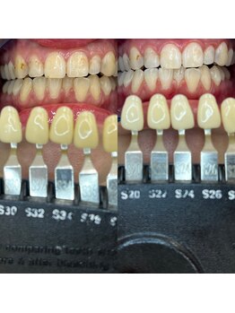 トウキョースワーズ 渋谷店(TOKYO SWRS)/#ホワイトニング #渋谷 #池袋