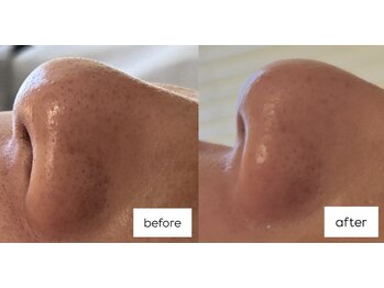 ウェヌ(VENE)/マツヤニWAX集中お手入れ