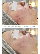 クレヴィー(Creviy)/REVlハーブピーリング