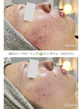 クレヴィー(Creviy)/REVlハーブピーリング
