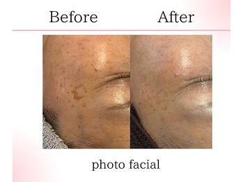 サロンツキ(salon tuki)/最新光機器症例/シミケア/徳島