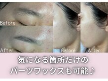 オアナヨーク(oana yoak)/気になるパーツの脱毛も可能♪