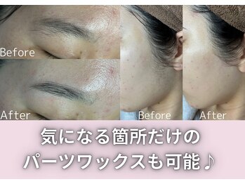 オアナヨーク(oana yoak)/気になるパーツの脱毛も可能♪