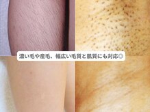 ピュアノア 三木店/脚|全身脱毛　三木|小野|西脇