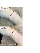 Blossom 【ホワイトニング/脱毛/韓国肌管理/毛穴洗浄】【3/23 NEW OPEN(予定)】/REDSHOT　二の腕