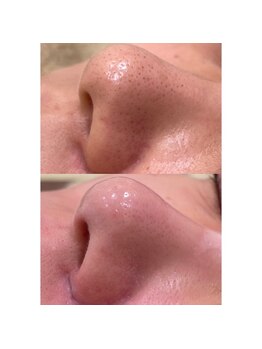 ソイズエステティクスの写真/《4周年半額キャンペーン実施中》毛穴大掃除◆毛穴洗浄＋吸引ゴッソリ除去今だけ《￥4400→￥2200》