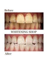ホワイトニングショップ 高岡店/beforeafter
