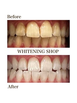 ホワイトニングショップ 高岡店/beforeafter