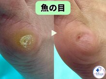 プラスワンフット 本厚木(+1 Foot)/タコ・魚の目ケア！痛みから解放