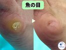 タコ・魚の目ケア！痛みから解放