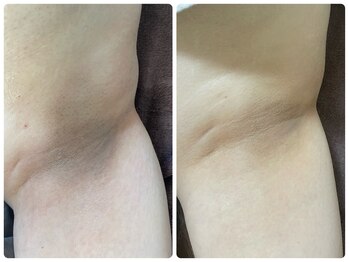 ビューティーホームサロン(Beauty Home Salon)/全身脱毛