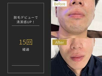 ステイゴールド 新百合ヶ丘(STAY GOLD)/おヒゲ脱毛の経過☆