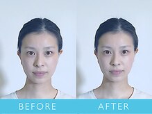 ビューティーマジック 恵比寿 広尾(beauty magic)/小顔矯正術　頭顔骨コース1回