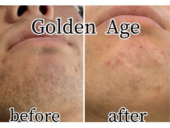 ゴールデンエイジ(Golden Age)/【ヒゲ脱毛】before&after