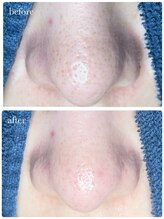 サロン ド ラム/【毛穴改善コース】５回目の効果