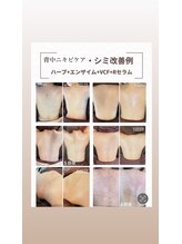 雅菜(miyabina)/美背中ケア！！輝く美背中へ