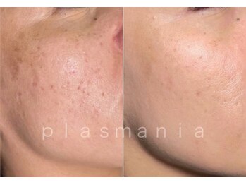 オリエンタルビューティー(ORIENTAL BEAUTY)/プラズマフェイシャル