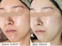 オーキッド(ORCHID)/開き毛穴撃退！