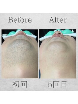 サンライズ(Sunrise)/Before After ☆