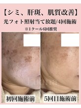 ルアナ(Luana)/《最新光フォト》シミ改善