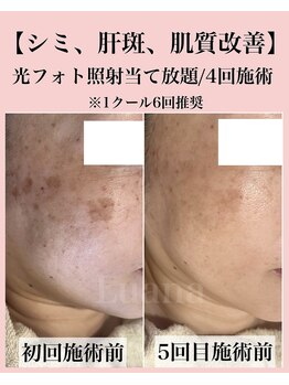 ルアナ(Luana)/《最新光フォト》シミ改善