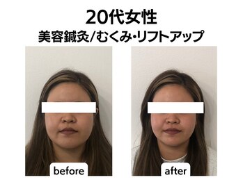 シン(SHINE)/美容鍼灸