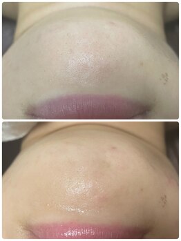 ビューティーホームサロン(Beauty Home Salon)/毛穴エクストラクション