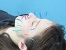 【不眠/自律神経】美容鍼　お顔＋全身　極みコース￥15,000～