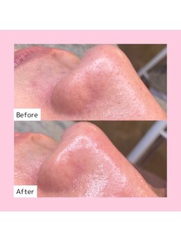 ホワイトラボ 新潟万代(White labo)/【施術例】ハイドロフェイシャル