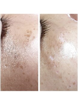 ルミエール(Lumiere)/ハリ感アップで毛穴レス