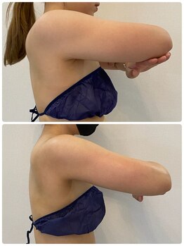 レミュ(Remu)/二の腕のお肉さよなら