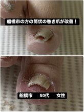 巻き爪じゅん 船橋店/筒状の巻き爪の痛み改善し笑顔に