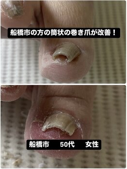 巻き爪じゅん 船橋店/筒状の巻き爪の痛み改善し笑顔に