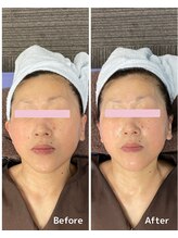 おおむら鍼灸接骨院/フェイシャル Before＆After