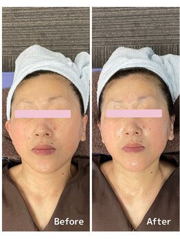 おおむら鍼灸接骨院/フェイシャル Before＆After