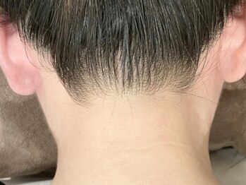 メルシートータルビューティー(MERCI)の写真/大人気うなじ脱毛¥2,200☆業界歴の長いスタッフが丁寧に施術し、あなたの美をサポートいたします◎