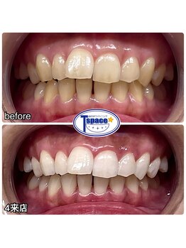 ティースペース 蒲郡店(T-space)/クリスタルWhiteコース