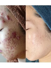 ソリッジ肌管理室/ニキビケアはお任せください