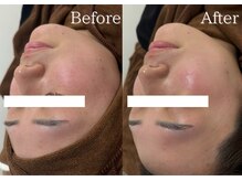 リネ(Rine)/ハーブピーリングでくすみ改善☆