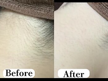 ビースキン 広島(BE:SKIN)/全身脱毛/フェイシャル/VIO