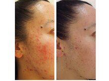 ハイケア グラン ギンザ(HYCARE GRAND GINZA)/日本ーの肌改善サロン実力/銀座