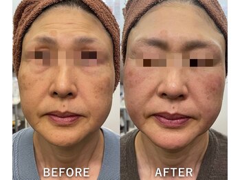 リラクゼーションサロン ラキ(laki)/サーモシェイプDEEPフェイシャル