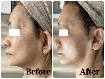 ルピア(L'pur)/お顔のビフォーアフター★