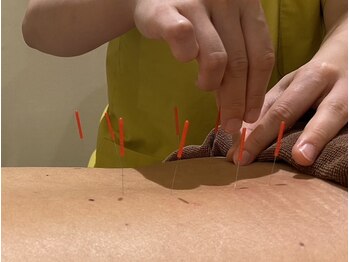 とんとん整骨院 鍼灸院 ときわ台/慢性腰痛も鍼で改善